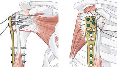 3     肌肉解剖学特点与临床意义:肱骨中上段的外侧有三角肌